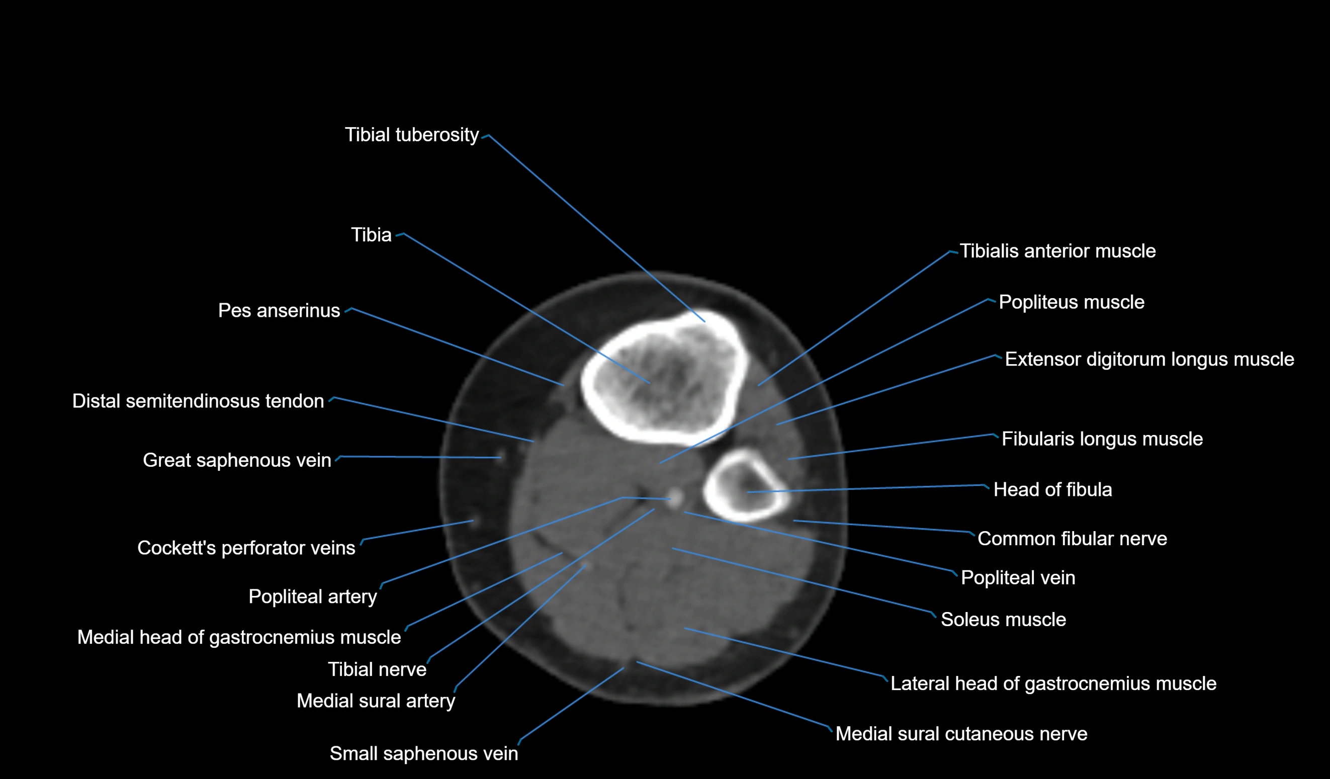 CT knee axial cross sectional anatomy labelled image-00049.webp